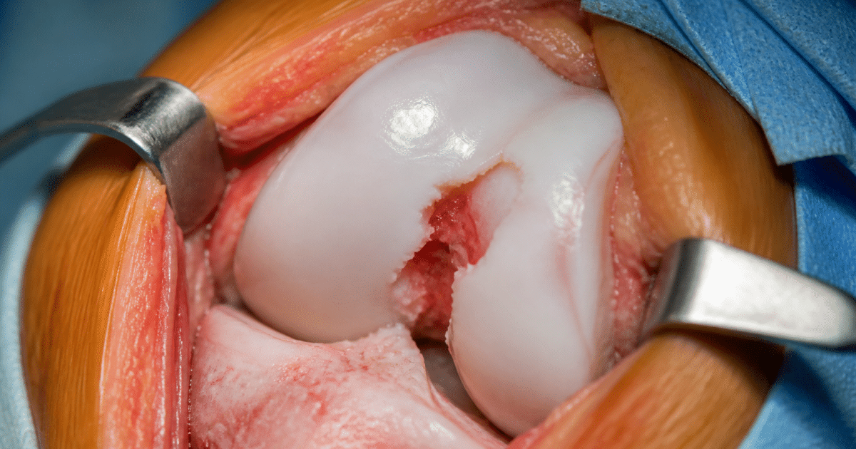 Genou en gros plan montrant cartilage endommagé et déchiré