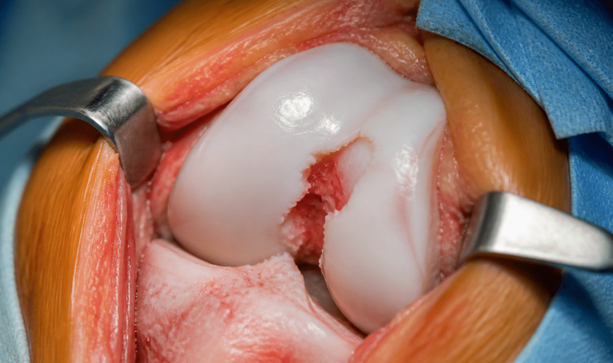 Genou en gros plan montrant cartilage endommagé et déchiré