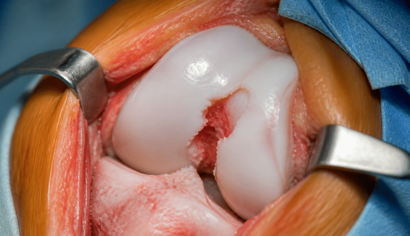Genou en gros plan montrant cartilage endommagé et déchiré